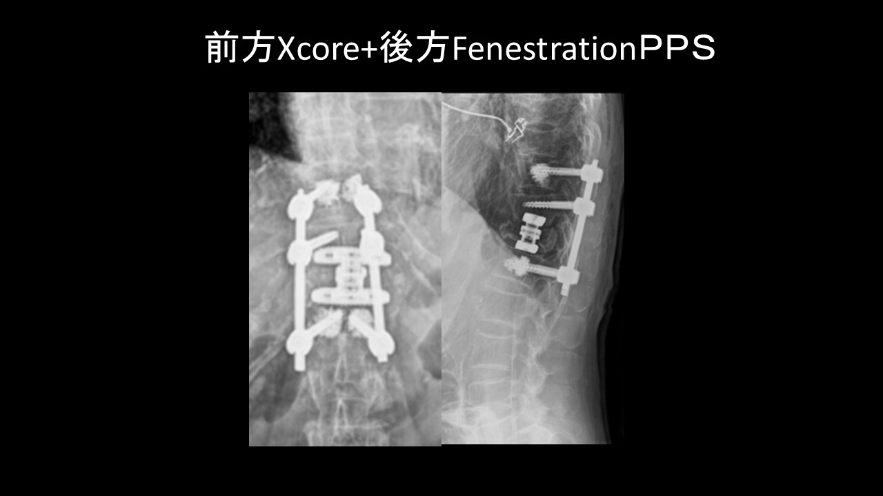 Xcoreとfenesetrat.JPG