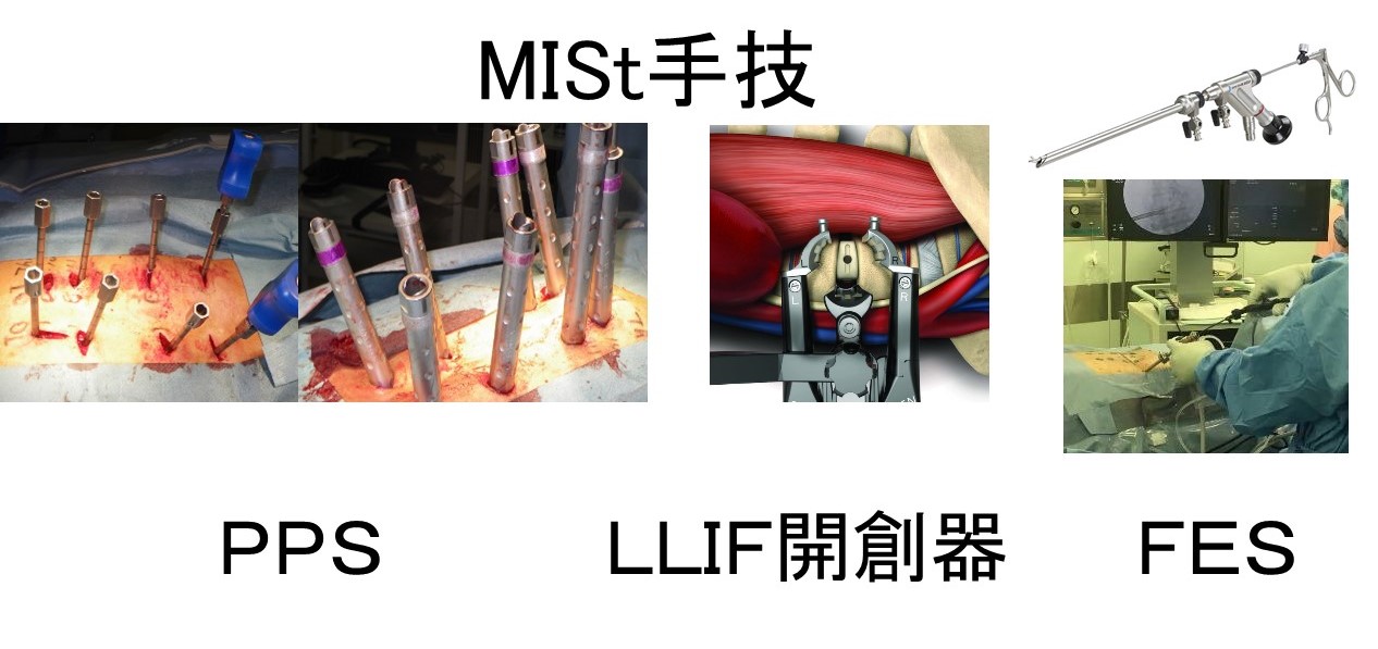 MIST手技における経皮的椎弓根スクリュー法 MISt手技における経皮的椎弓根スクリュー法―基礎と臨床応用 | 日本MISt