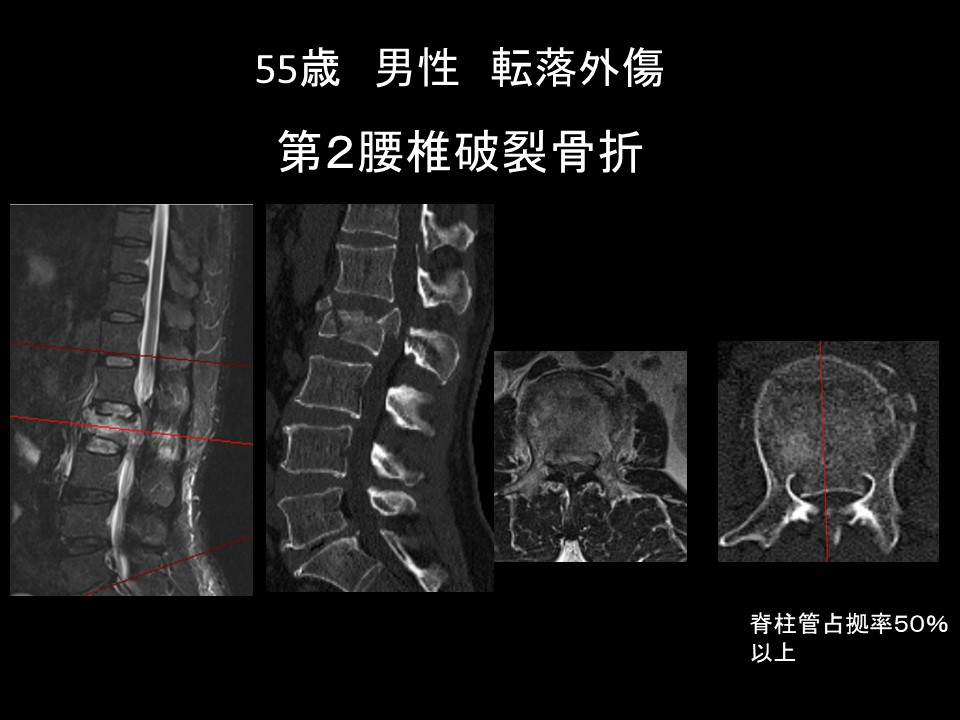 【裁断済み】OS NEXUS13 脊椎の再建法―すべり症から脊柱変形まで メジカルビュー社｜整形外科｜新OS NEXUS No.13 脊椎の再建法