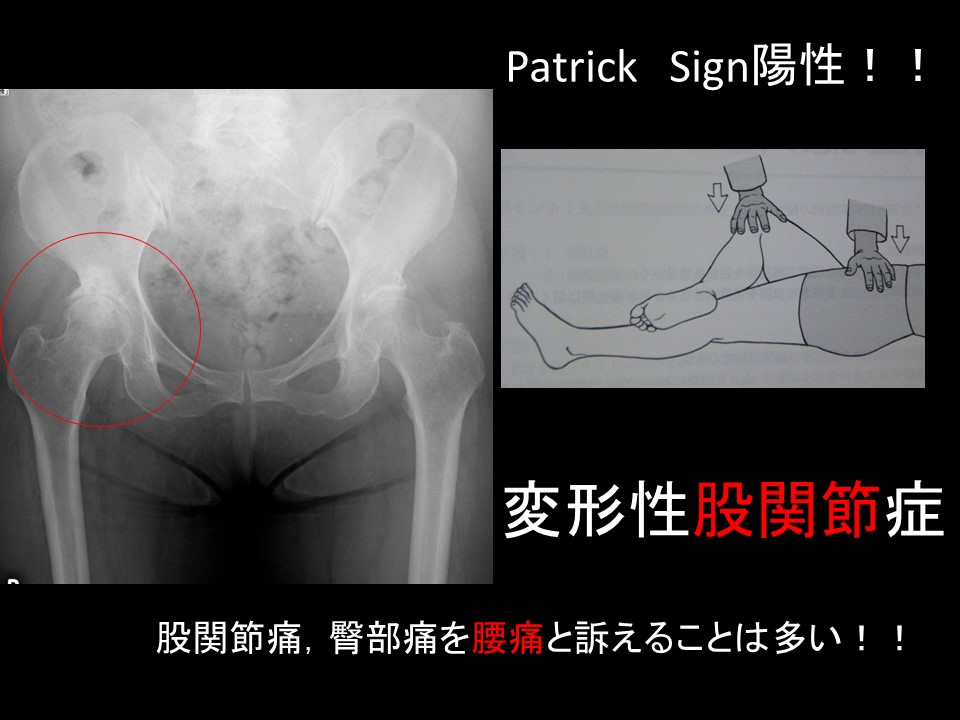 椎間板ヘルニア