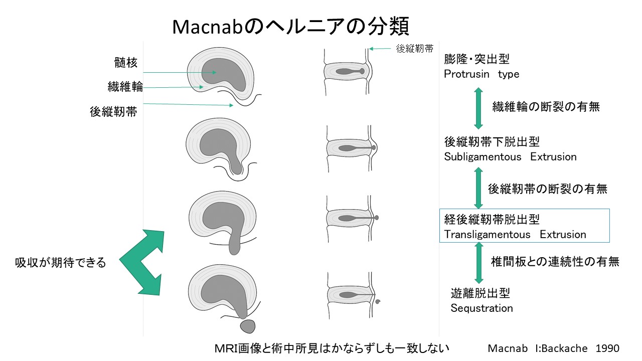 ヘルニア 日本発のコンドリアーゼが世界へ！腰椎椎間板ヘルニア治療の新た