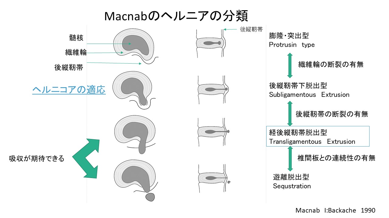 手術なしで椎間板ヘルニアを縮小？椎間板内酵素注入療法注射の効果と