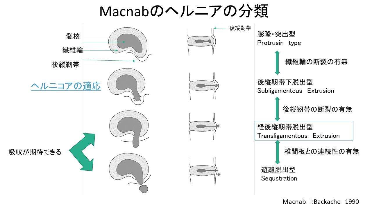 ヘルニア 椎間板内酵素注入療法とは？ヘルニアの痛みを低侵襲に改善する方法