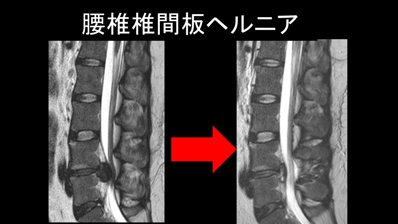 手術は必要？腰椎椎間板ヘルニアの自然経過と治療法を専門医がわかり