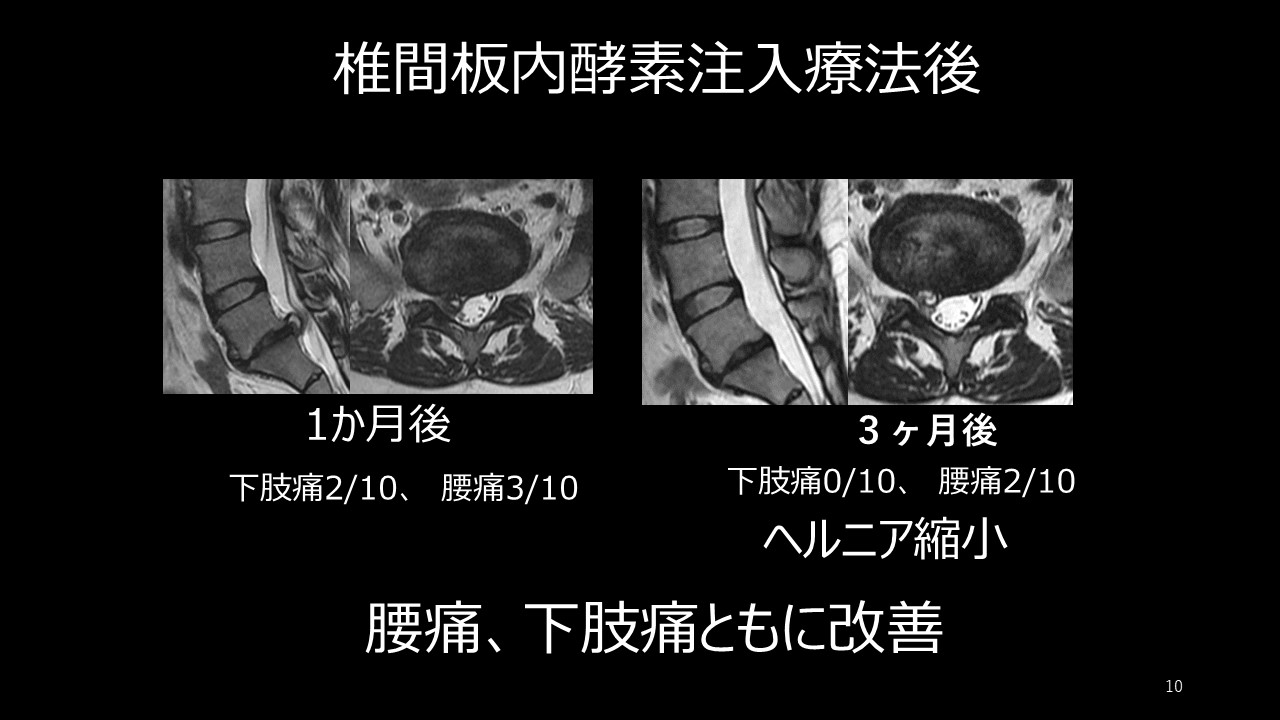 手術なしで椎間板ヘルニアを縮小？椎間板内酵素注入療法注射の効果と