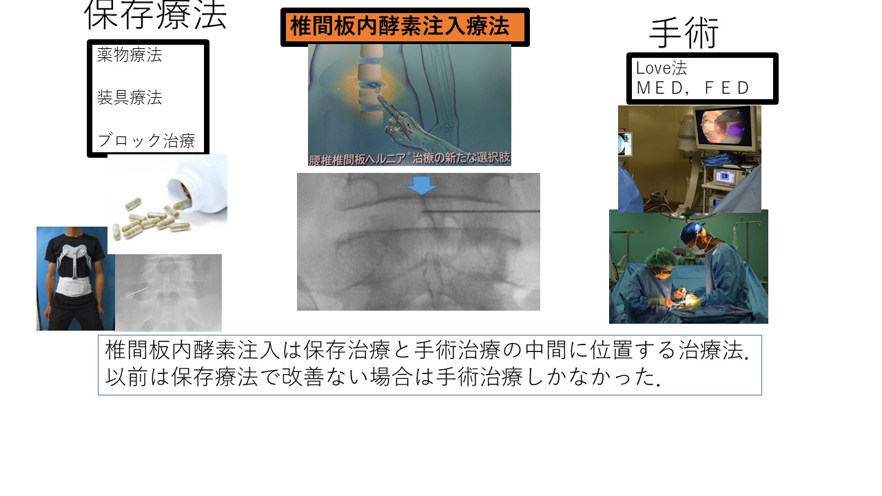 椎間板内酵素注入療法とは？ヘルニアの痛みを低侵襲に改善する方法