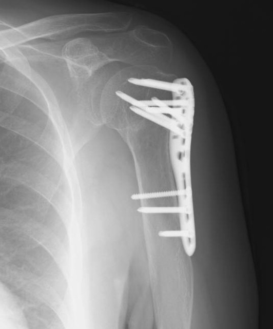 骨折治療法 肩の骨折治療】上腕骨近位端骨折の手術後リハビリ、早期運動は効果的