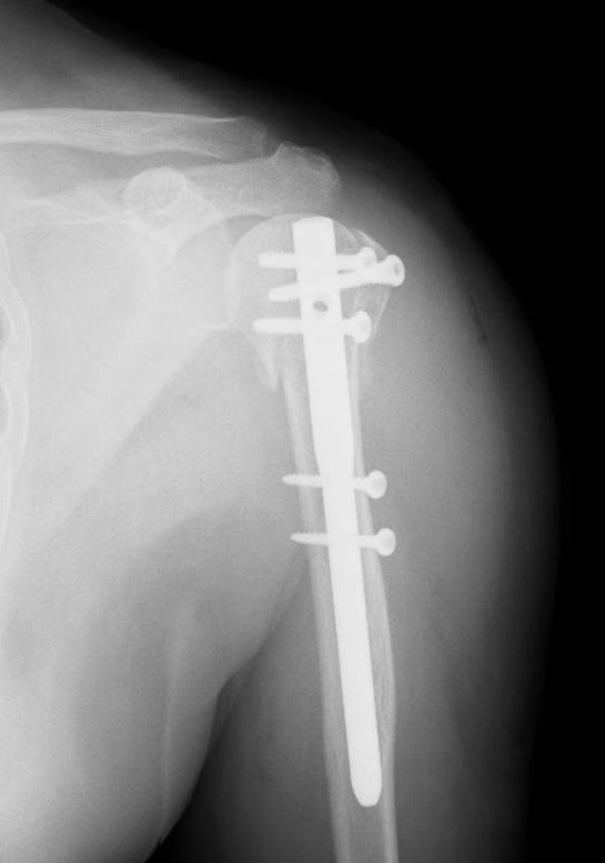 肩の骨折治療】上腕骨近位端骨折の手術後リハビリ、早期運動は効果的