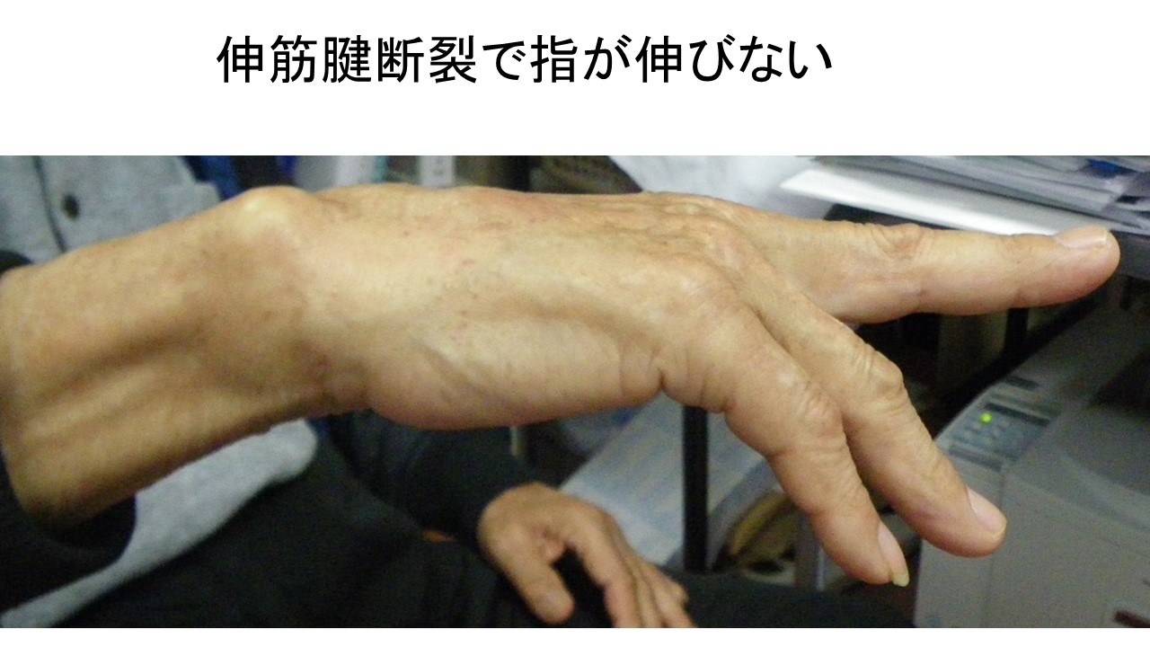 手首の痛みと腱断裂：Sauvé-Kapandji法が有効な理由 ｜ 成尾整形外科病院