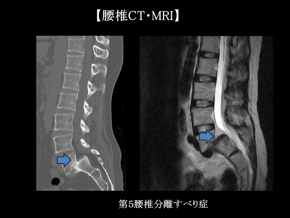 分離すべり症とは？原因・診断方法・治療法を専門医が徹底解 ｜ 成尾