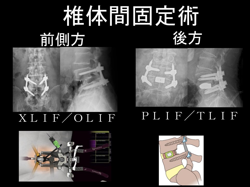 腰椎手術の落とし穴！固定術と隣接椎間障害の関係を徹底解説 ｜ 成尾