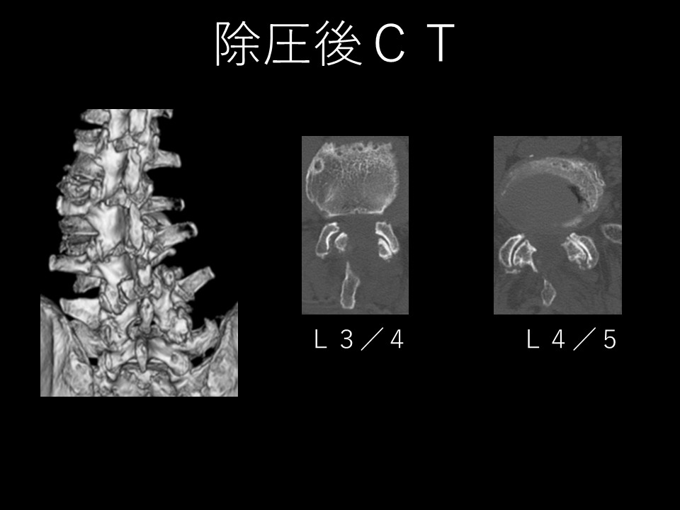 骨移植 最近の進歩 Cobb角20°以上の変性側弯症に最小侵襲手術は有効か？最新研究の