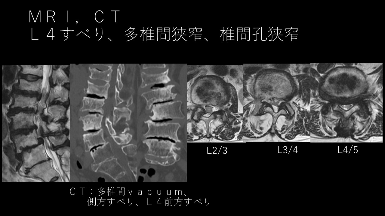 手術後の腰の傾きが悪化？腰椎変性側弯症の矯正手術に潜むリスクとその