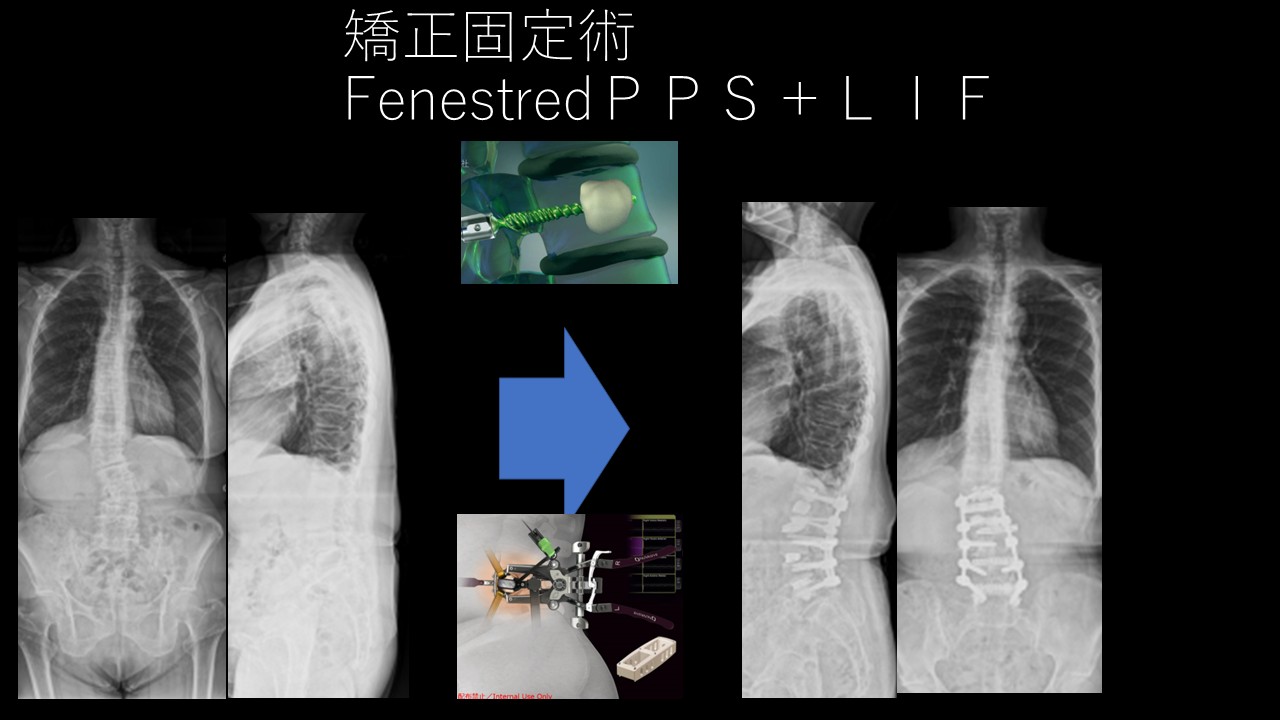 手術後の腰の傾きが悪化？腰椎変性側弯症の矯正手術に潜むリスクとその