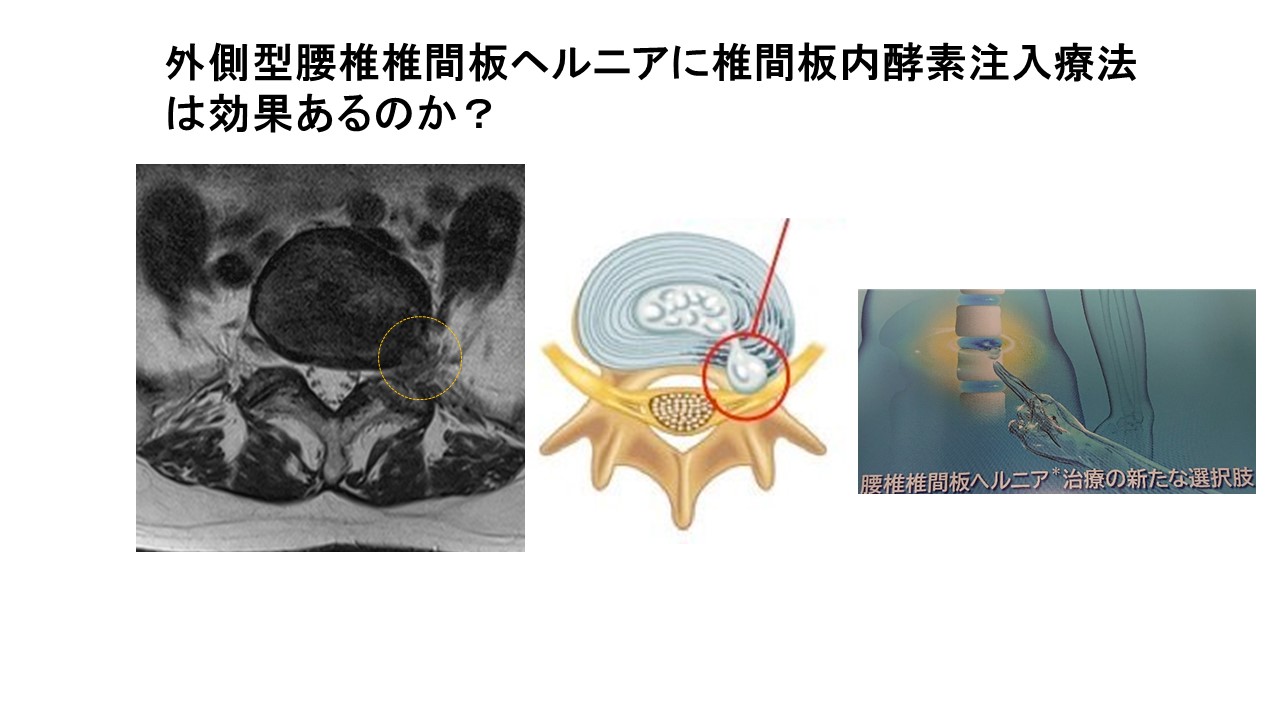 ヘルニアの外科 ヘルニアの外科