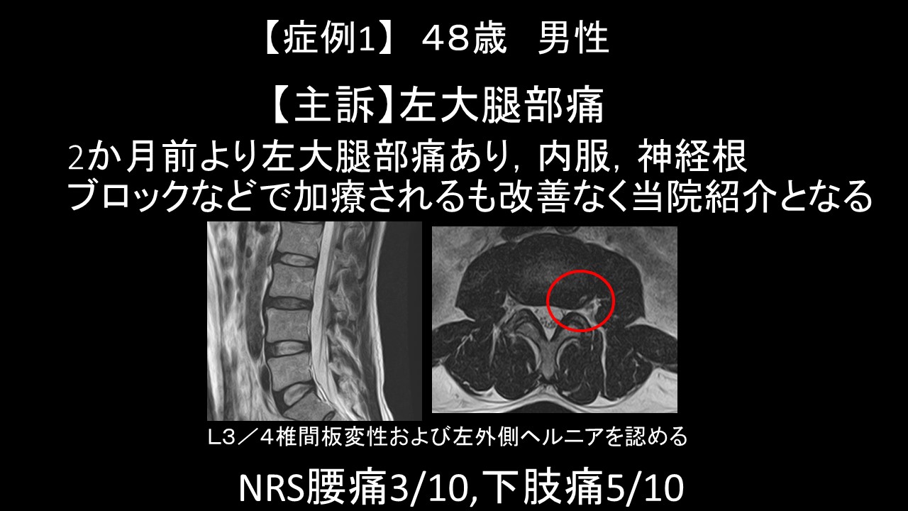 外側型腰椎椎間板ヘルニアに対する椎間板内酵素注入療法 ｜ 成尾