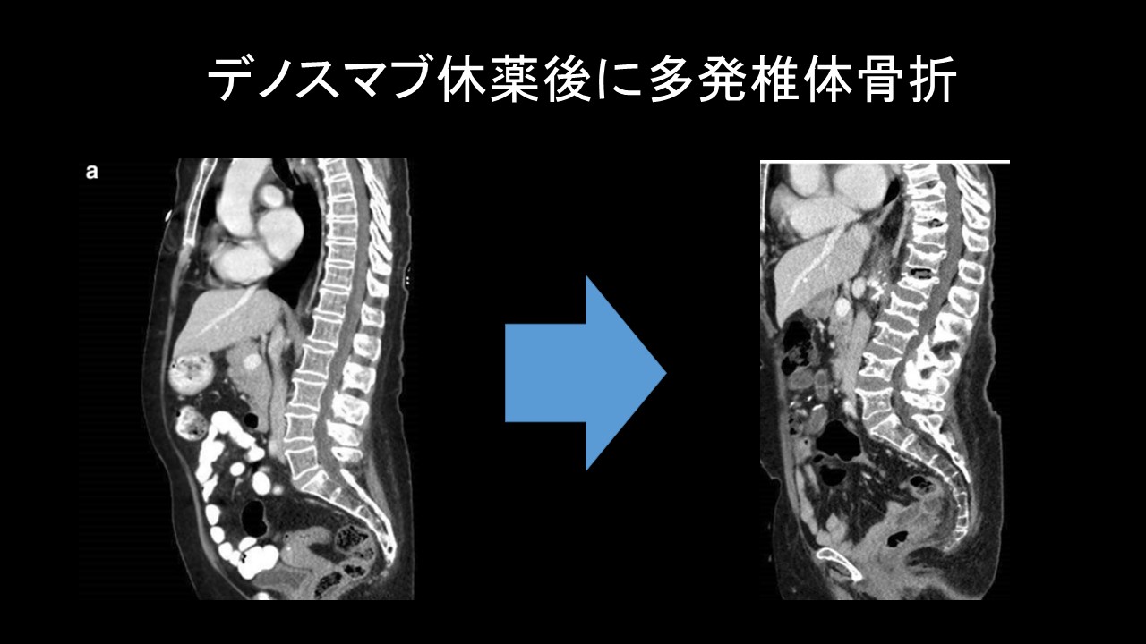 骨粗しょう症治療薬の中断リスク:デノスマブ中止後の骨折に要 骨粗しょう症治療薬の中断リスク:デノスマブ中止後の骨折に要