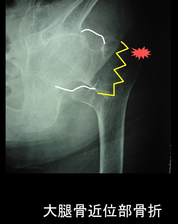1. 骨粗鬆症治療の最新戦略2024！個人に合わせた骨折予防 ｜ 成尾