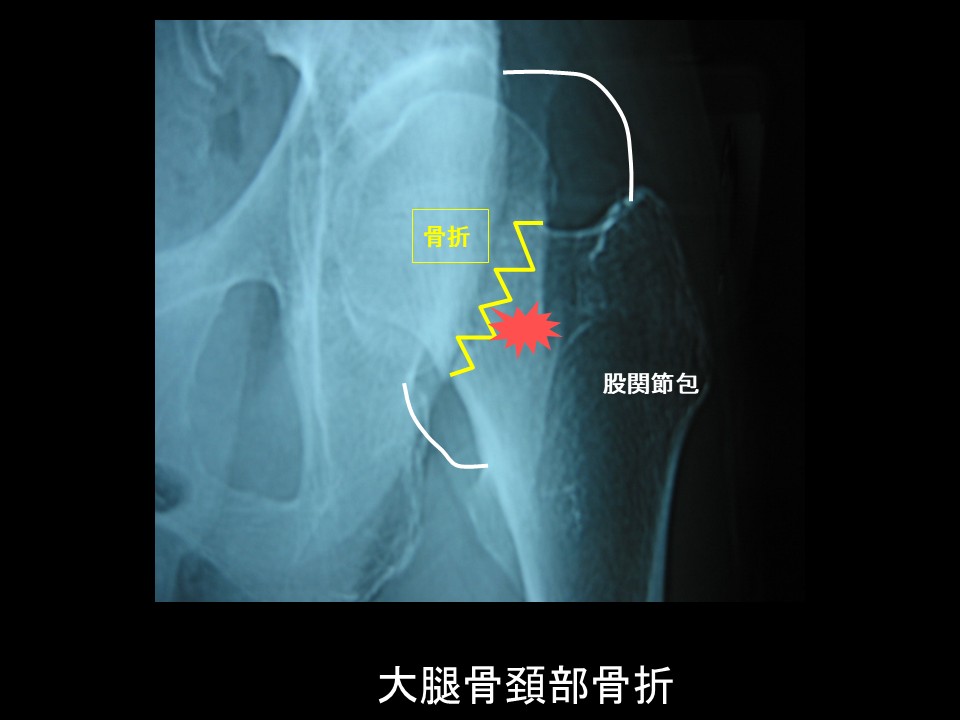 大腿骨近位部骨折 | オンラインストア｜看護・医学新刊