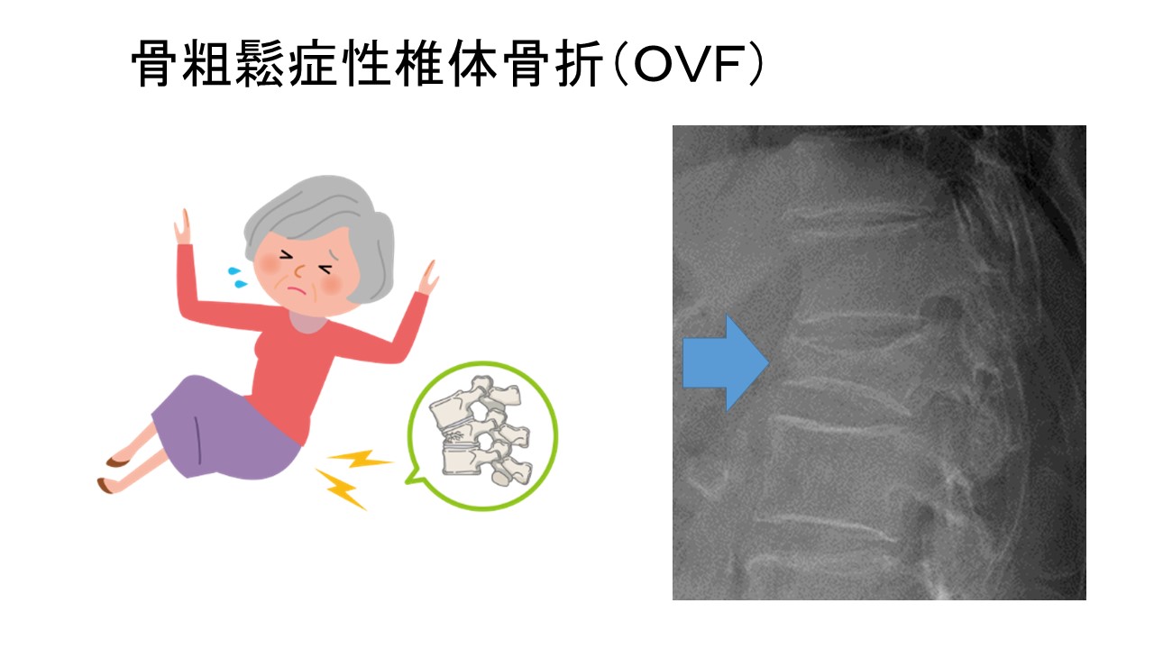 骨折の保存的治療 日常診療の疑問に答える 本