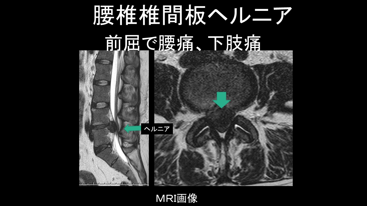 椎間板ヘルニア手術の全内視鏡手術のメリットとは？全内視鏡 vs 開放