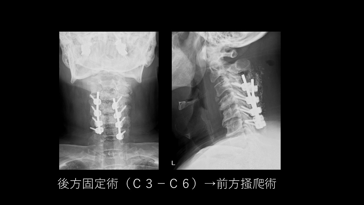 頸椎化膿性脊椎炎の治療法とは？早期発見と手術の重要性を徹底解説