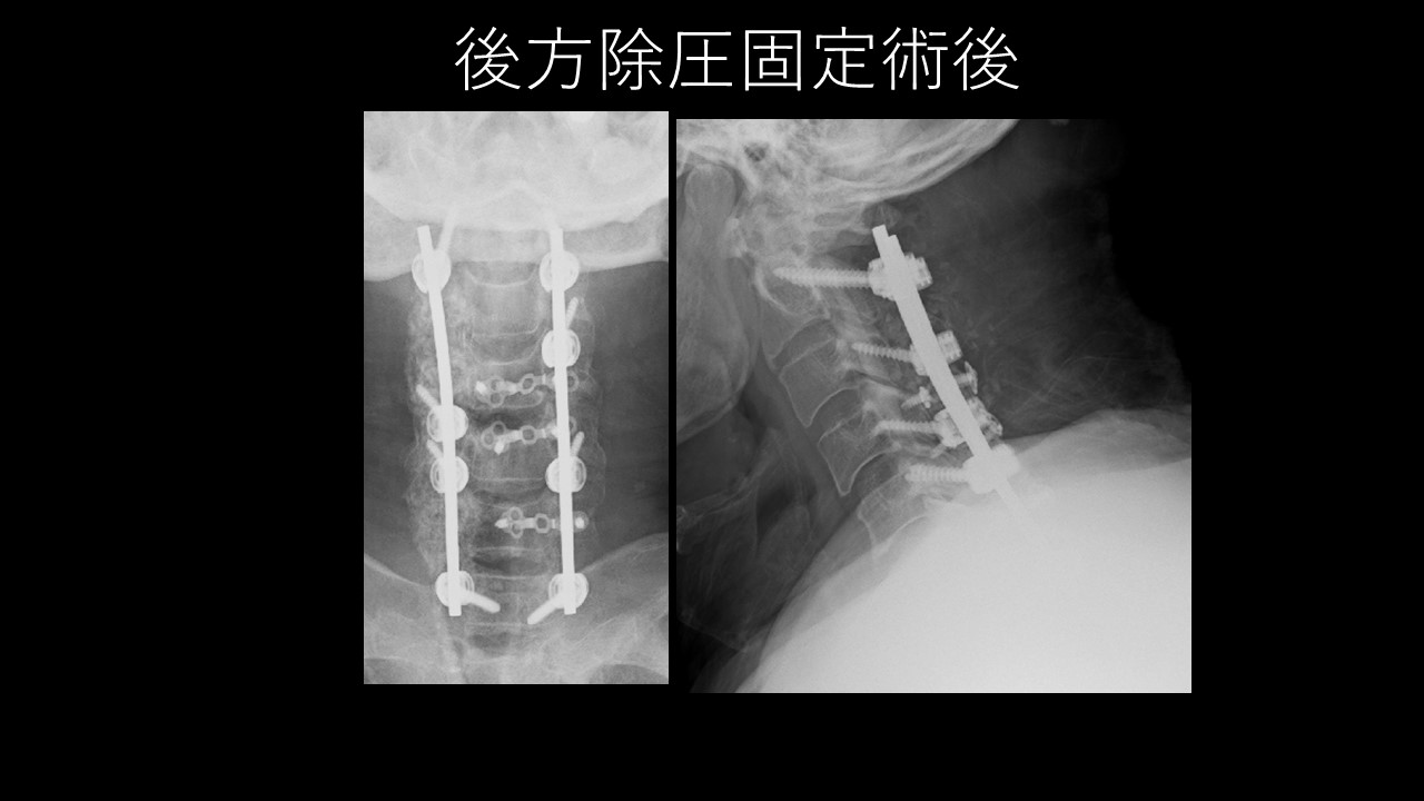 頚椎後縦靭帯骨化症（OPLL）とは？症状・原因・最新の手術方法を専門医