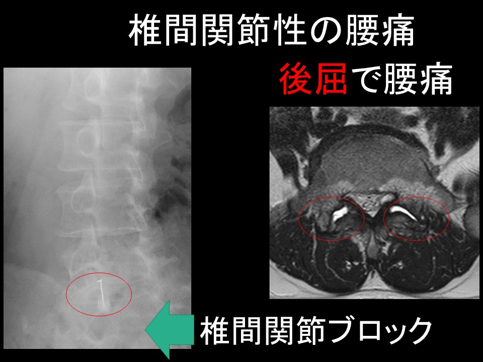 85％が原因不明？非特異的腰痛の正体と最新治療を解説 ｜ 成尾