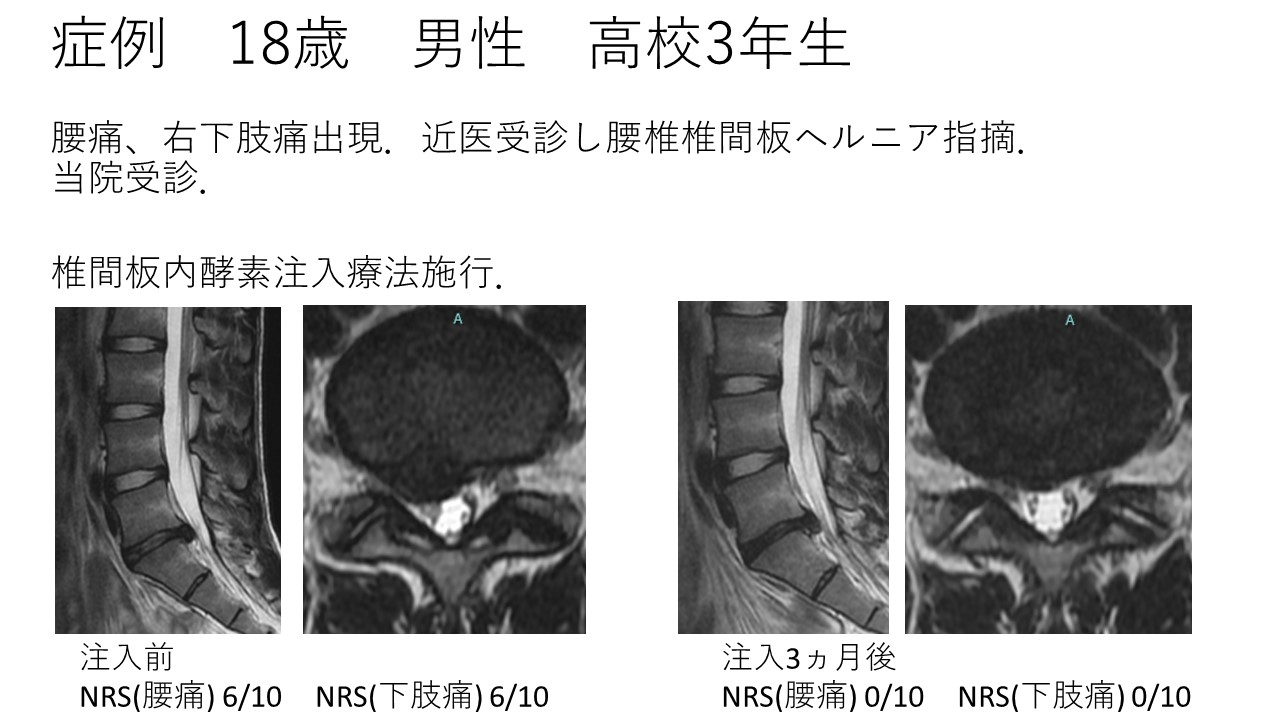 椎間板酵素注入療法（ヘルニコア）～20歳未満の治療～ ｜ 成尾整形外科病院