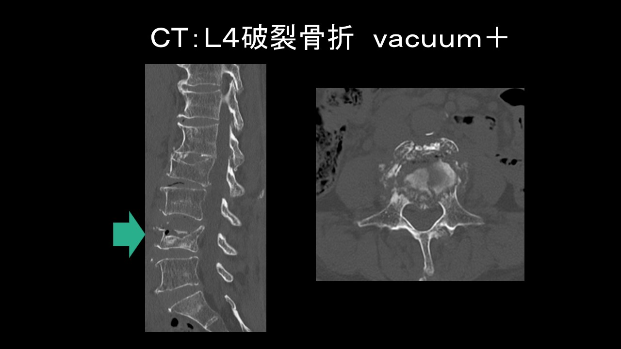 骨折様 VP9 骨粗鬆症性椎体骨折に対する脊柱再建術 ｜ 成尾整形外科病院