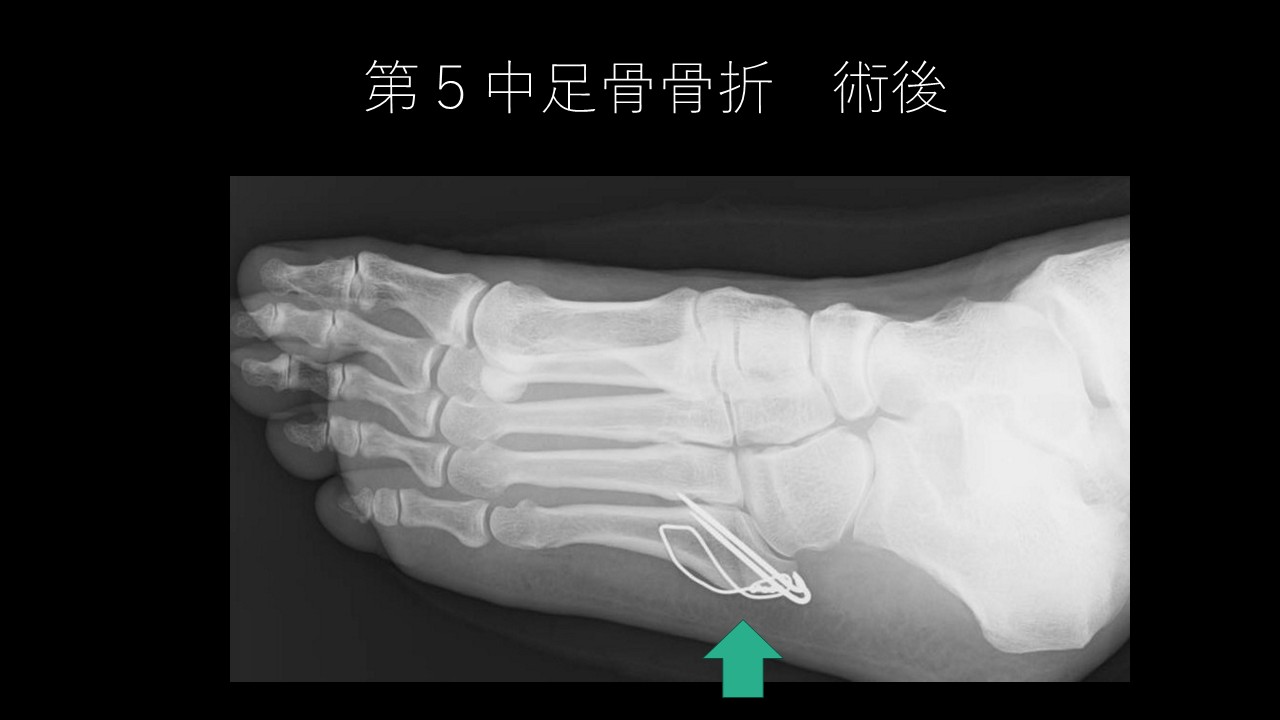 第5中足骨骨折とは？高校生と中高年女性に多い理由と予防策を