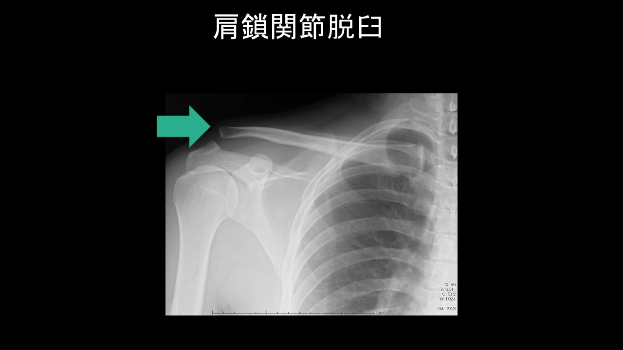 肩鎖関節脱臼を徹底解説！診断から治療・リハビリまでの最新ガイド