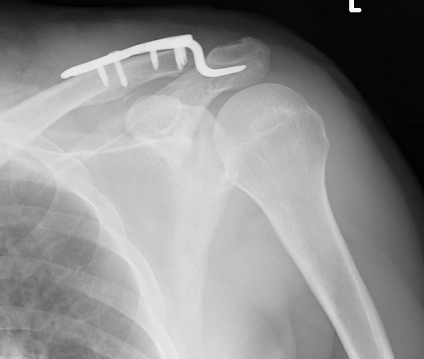 肩のケガで多い『肩鎖関節脱臼』とは？治療法と手術のタイミングを徹底