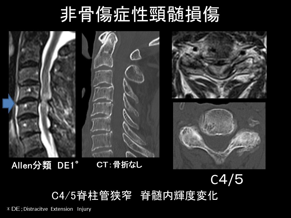 非骨症性頚髄損傷には早期手術が有用である！！善は急げ！！その１ ｜ 成尾整形外科病院