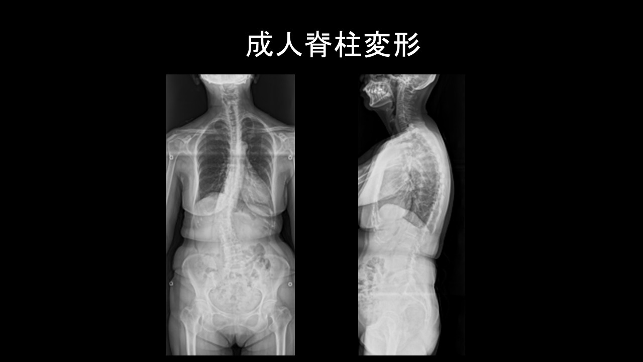 成人脊柱変形と仙腸関節痛の関係性：成人脊椎変形の手術で仙腸