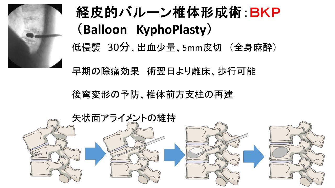 骨粗鬆症による脊椎圧迫骨折の再骨折リスクとは？最新の治療法と