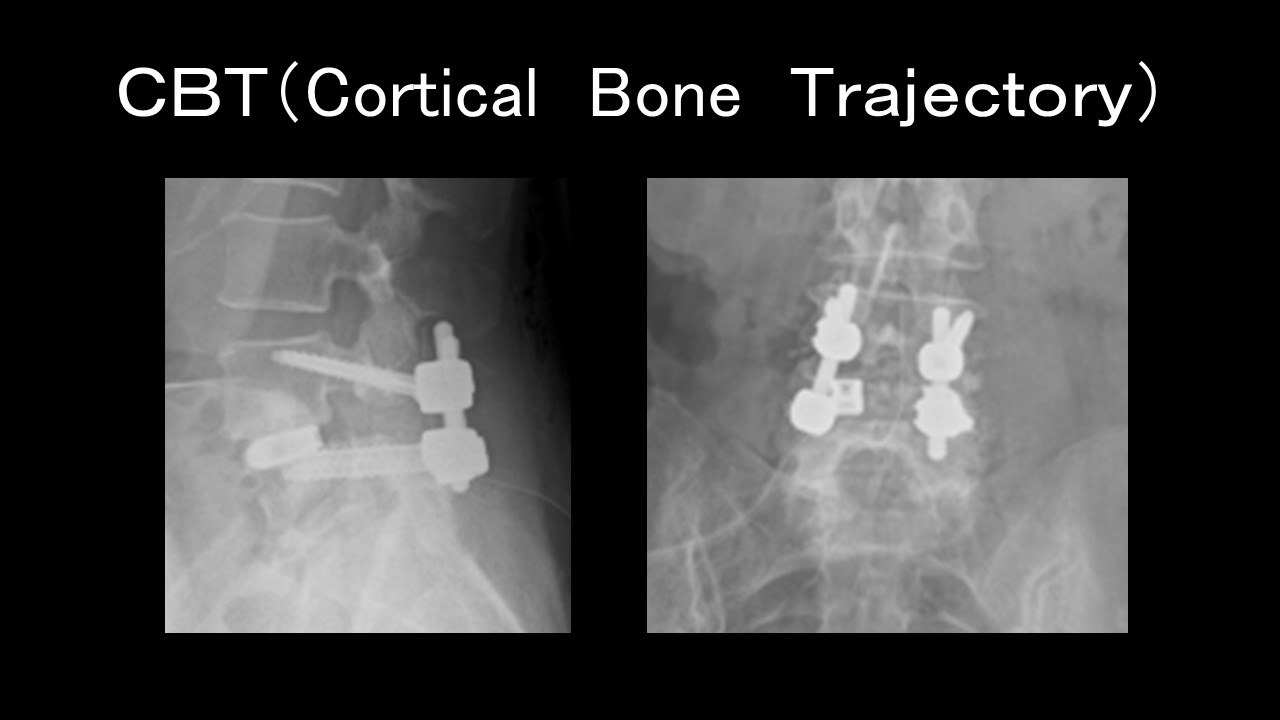 【裁断済】脊椎手術パーフェクト SPINE 裁断済】脊椎手術パーフェクト SPINE 脊椎手術パーフェクト