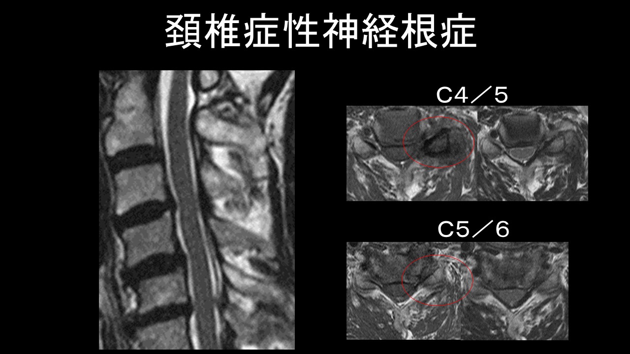 保存療法 vs 手術、どっちが効果的？頚椎症性神経根症の最新治療ガイド