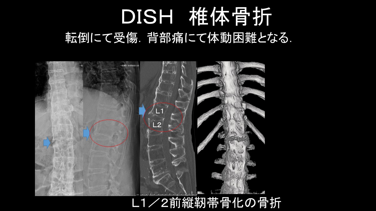 高齢者に増えるDISHとは？軽い転倒でも危険な脊椎骨折の実態 ｜ 成尾