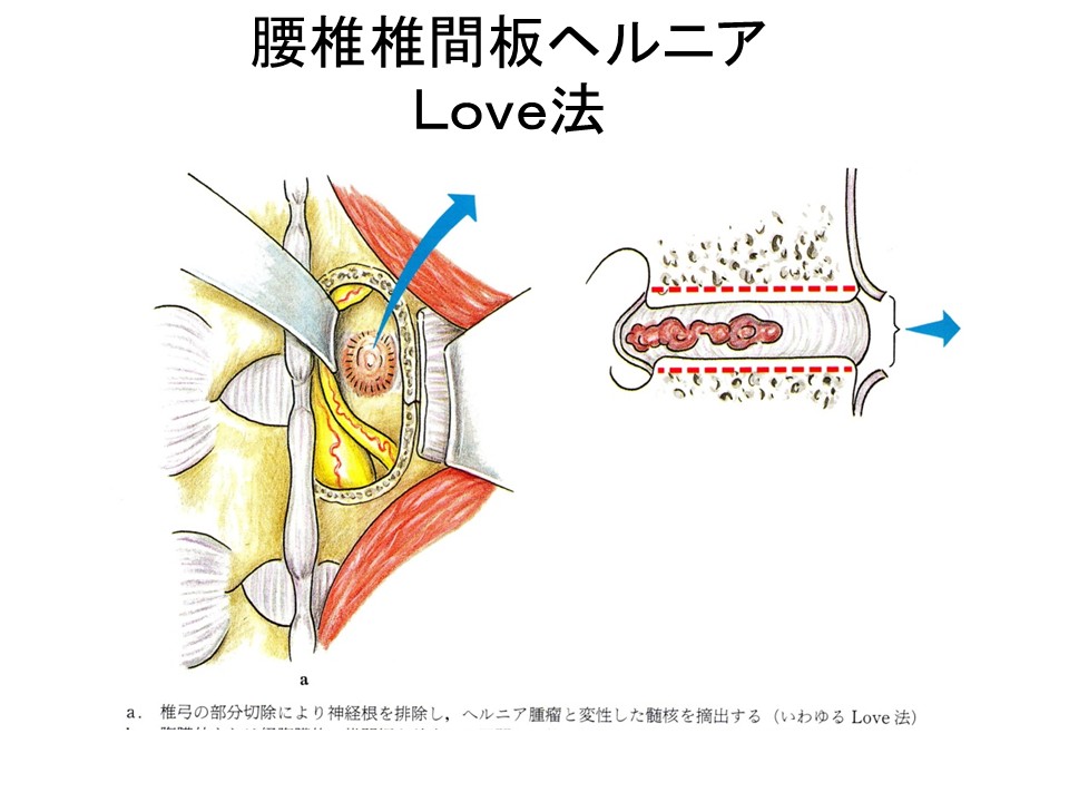 椎間板ヘルニア手術の全内視鏡手術のメリットとは？全内視鏡 vs 開放