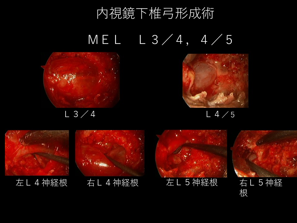 Cobb角20°以上の変性側弯症に最小侵襲手術は有効か？最新研究の