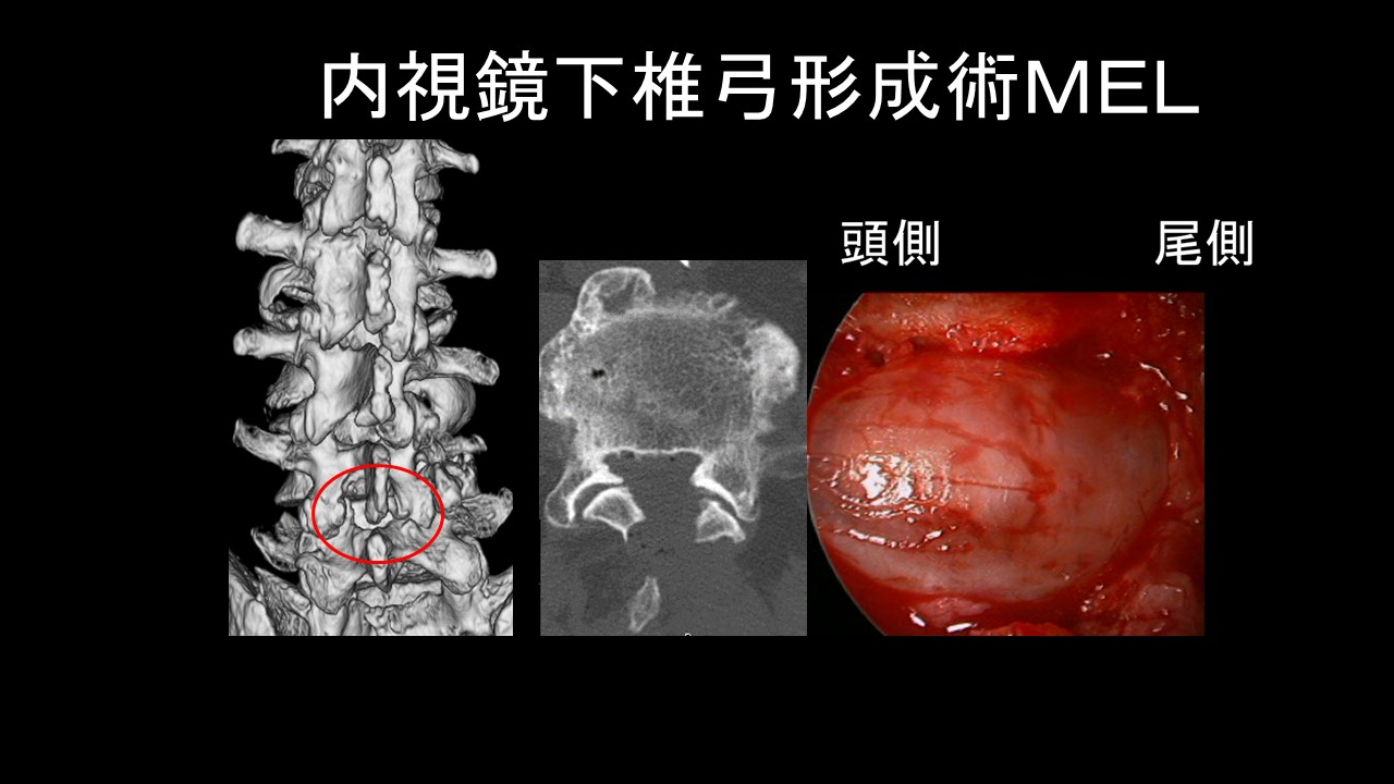 腰部脊柱管狭窄症の手術、再手術率は？除圧術と固定術の比較結果