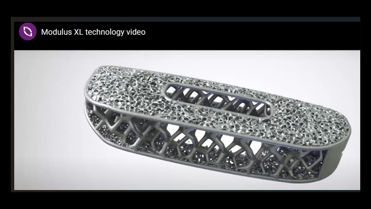腰椎固定術の進歩！NuVasiveの3Dプリントチタンケージ「Modulus