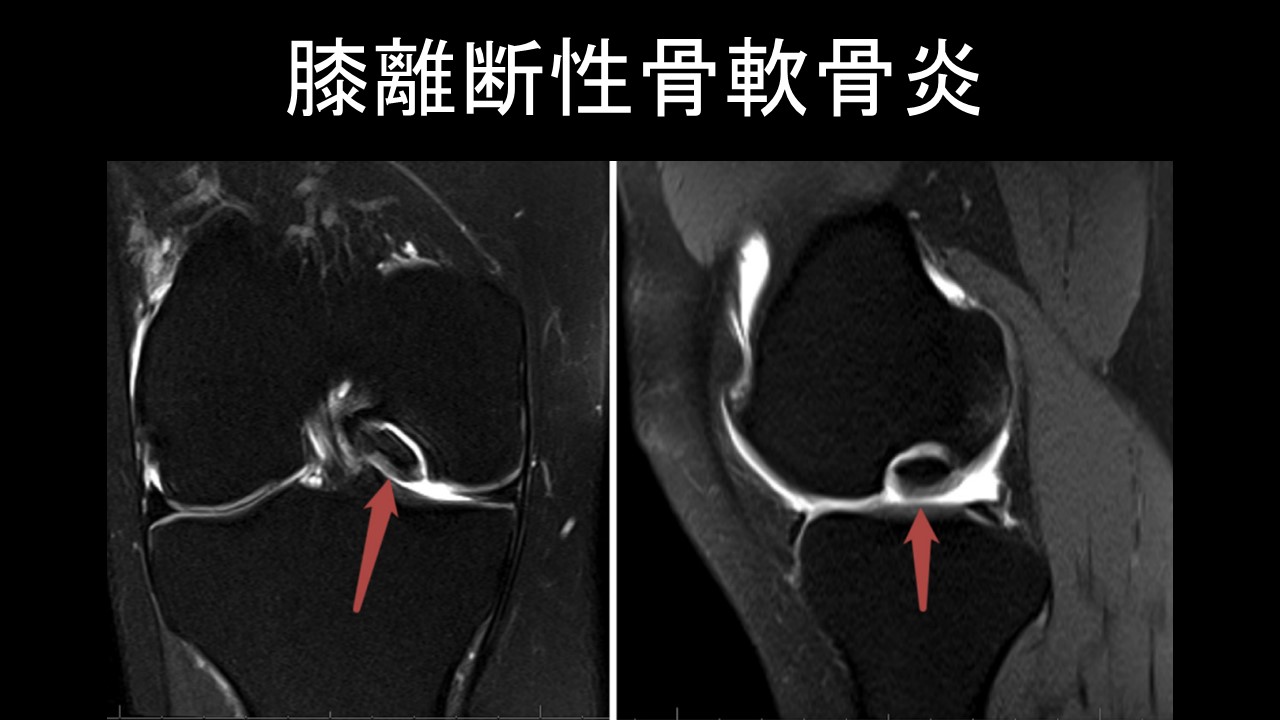 MRIで理解する膝の外傷・障害 110A5 | 膝靭帯損傷 国試 | テコプラ