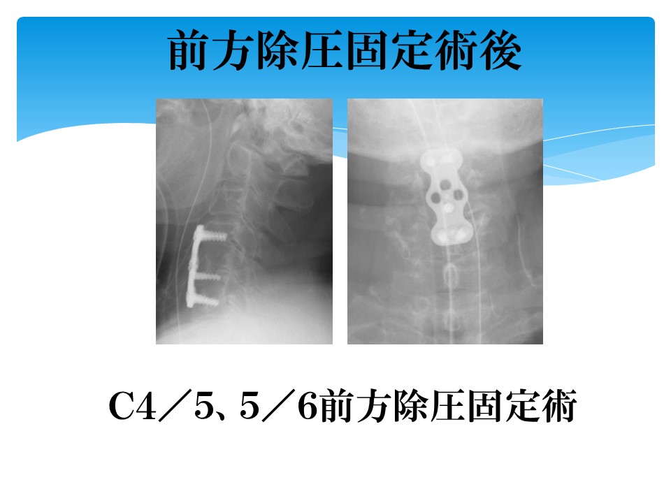 頚椎後縦靱帯骨化症 | 藤枝平成記念病院