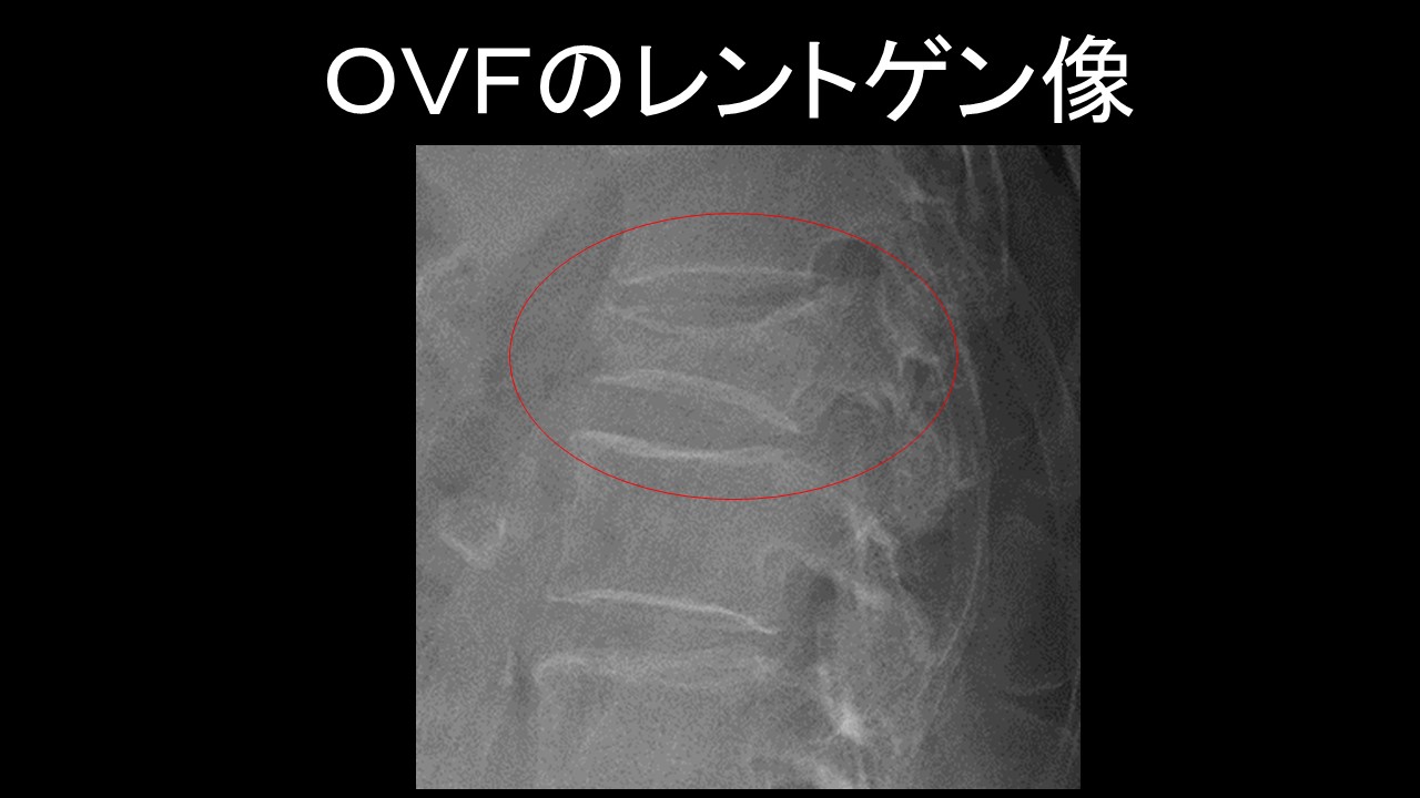 骨粗鬆症性椎体骨折 （OVF:osteoporotic vertebral fracture） その１ 