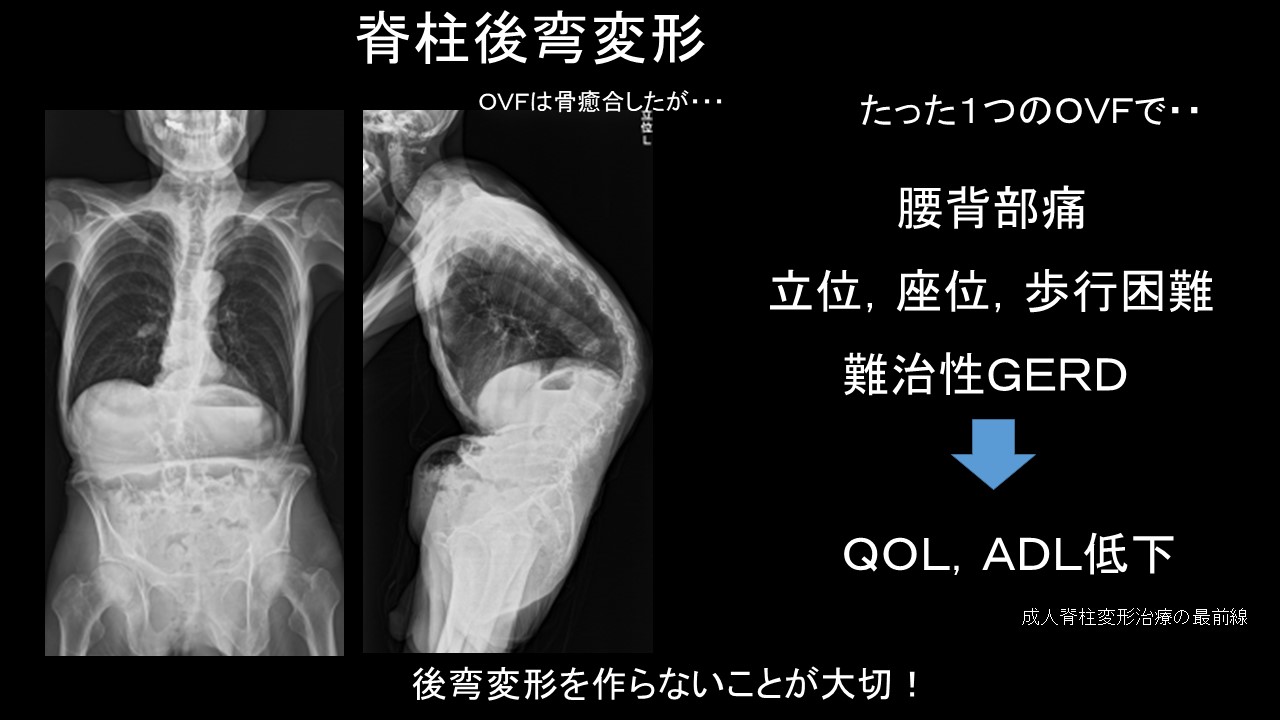 骨粗鬆症性椎体骨折の治療の発展：BKPで複数椎体手術が可能に