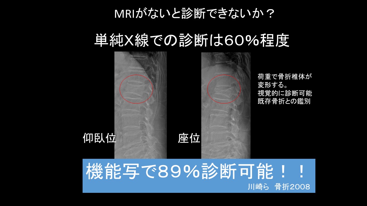 骨粗鬆症性椎体骨折（OVF:osteoporotic vertebral fracture