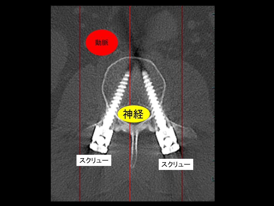 脊椎手術の新時代！ロボット支援技術のメリットと課題 ｜ 成尾整形外科病院