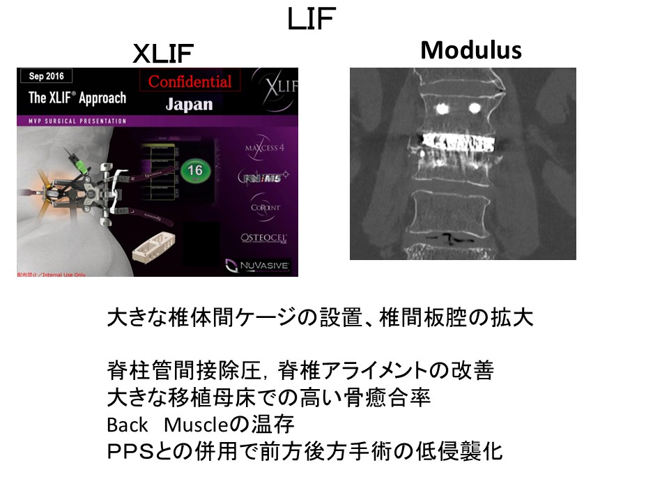MISt手技における側方経路椎体間固定術（LIF）入門 MISt手技における側方経路椎体間固定術（LIF）入門 MISt手技